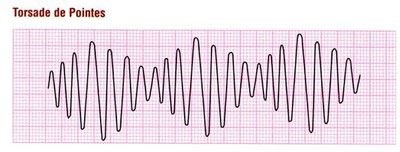torsades de pointes